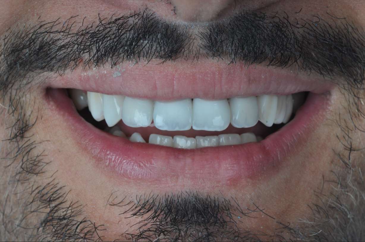 Sorriso natural após facetas de resina